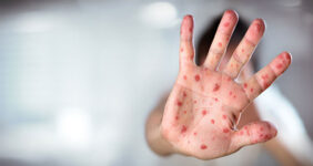 موج سرخک در بنگلادش جان ۵۰۰ کودک را گرفت موج سرخک در بنگلادش جان ۵۰۰ کودک را گرفت