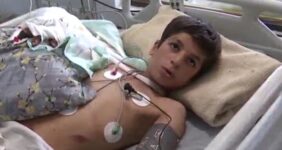 یک جراحی کمنظیر در بروجرد؛ دست قطعشده نوجوان دوباره به بدن بازگشت یک جراحی کمنظیر در بروجرد؛ دست قطعشده نوجوان دوباره به بدن بازگشت